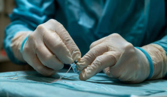 Хирургия язвы желудка