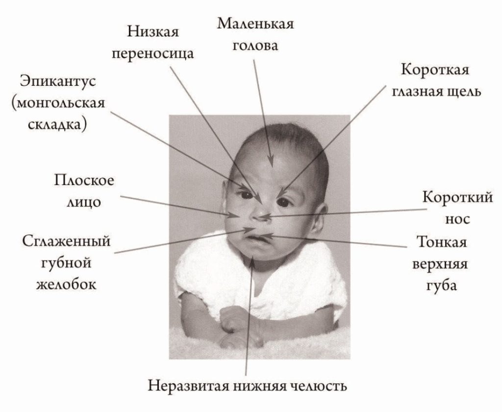 Фетальный алкогольный синдром